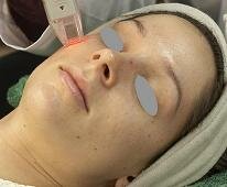 lazer ile cilt yenileme