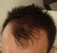 erkelerde sac dokulmesi