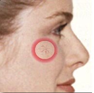 yüzde kilcal damar catlamasi