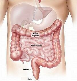 kalin bagirsak dügümlenmesi