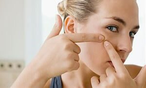 saracoglu sivilce kuru