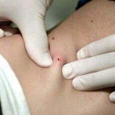 kırım kongo hastaligi