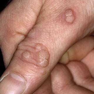 ev yapimi sigil tedavisi