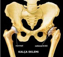 kalca-kireclenmesi