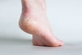 topuk catlaklarina aspirin